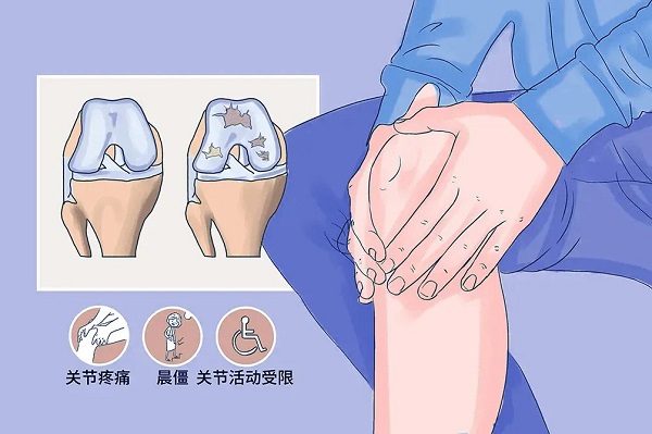 膝关节骨性关节炎