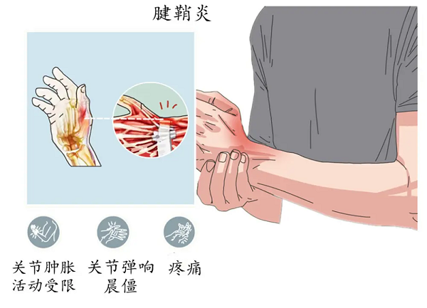 腱鞘炎