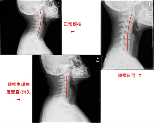 颈椎生理曲度