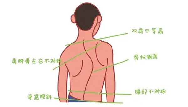 脊柱侧弯体态表现