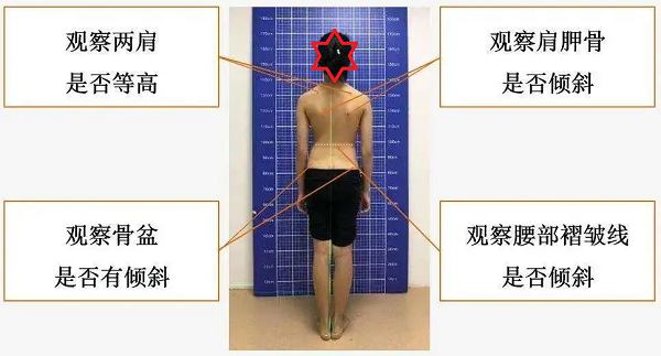 脊柱侧弯观察体态变化方法