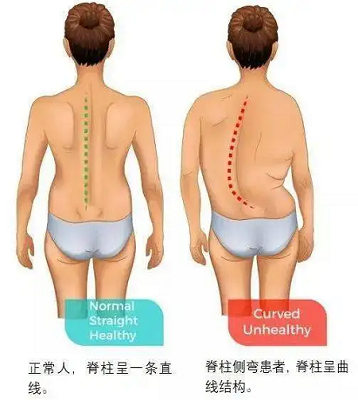 正常人和脊柱侧弯对比图