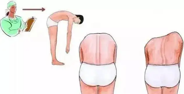 脊柱侧弯筛查后视图
