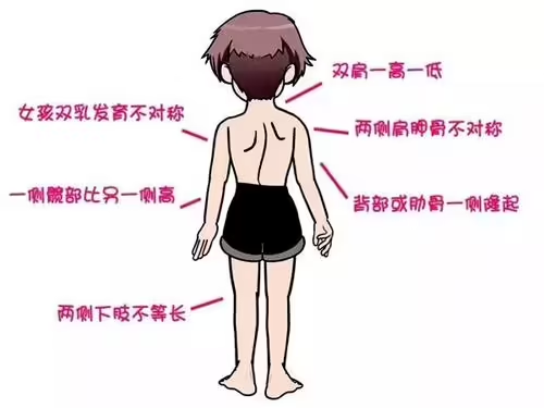 女性脊柱侧弯特征