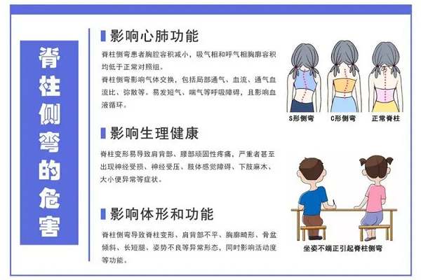 脊柱侧弯危害