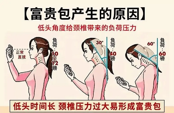 富贵包产生原因