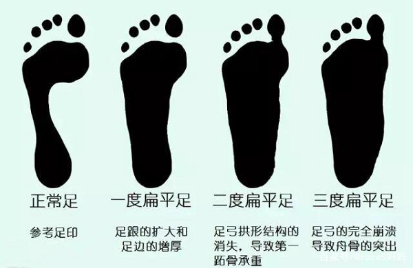 正常足和扁平足对比示意图