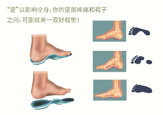直乐3D打印矫形鞋垫