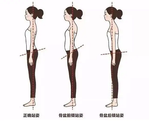 骨盆不同状态站姿差异图