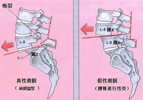 真性滑脱假性滑脱对比图