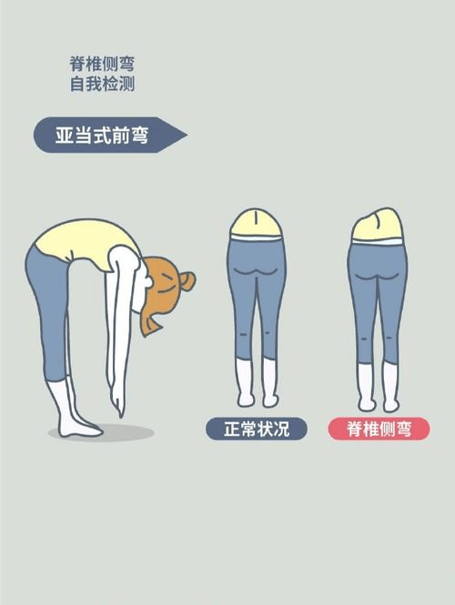 脊柱侧弯体前屈测试