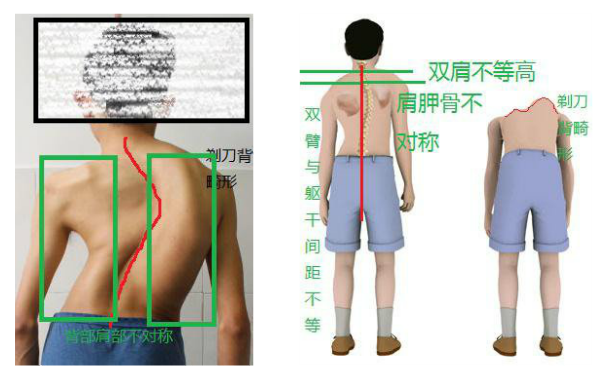 脊柱侧弯典型症状