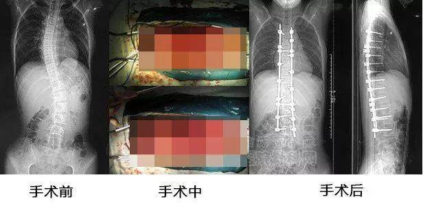 脊柱侧弯手术很血腥，请自行搜索了解
