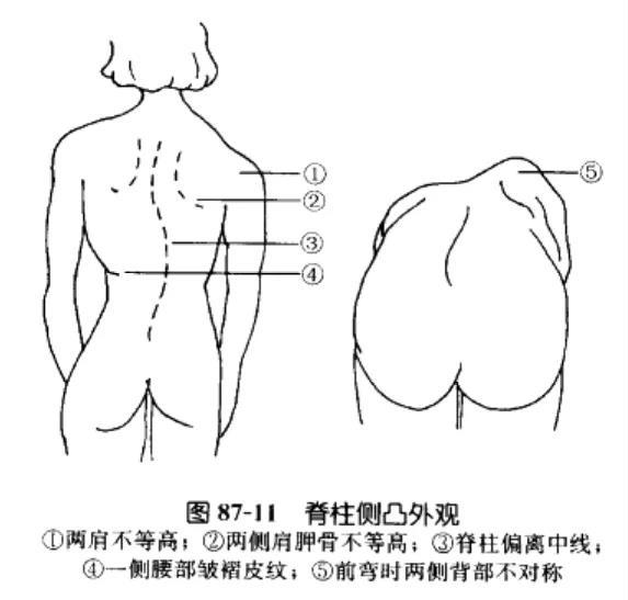 脊柱侧弯外观特征