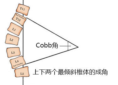 cobb角测量方法