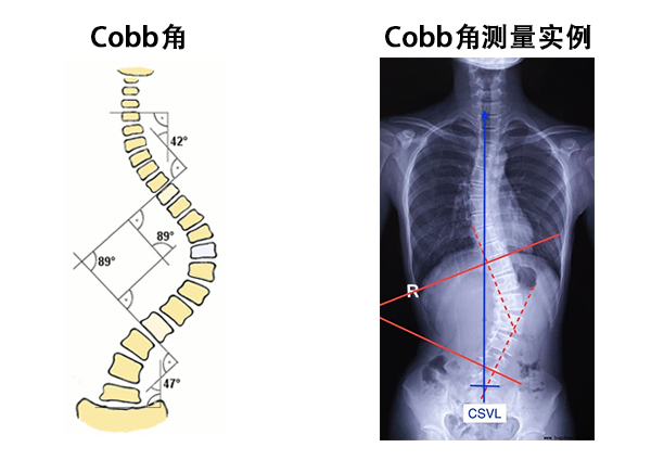 cobb角测量实例