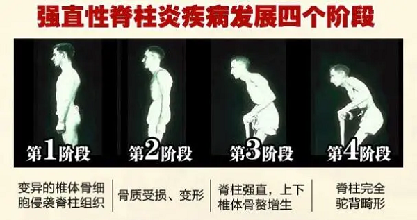 强直性脊柱炎疾病发展四个阶段