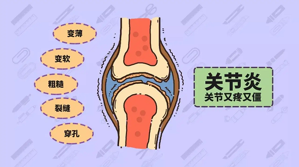 关节炎常见症状表现