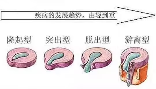 椎间盘突出疾病发展趋势