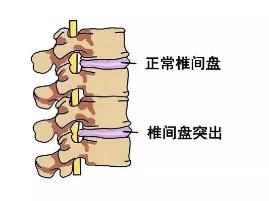 正常椎间盘和椎间盘突出对比图