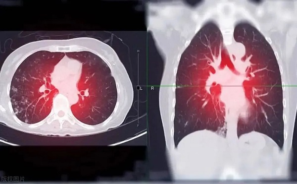 白肺影像