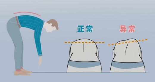 脊柱侧弯弯腰测试