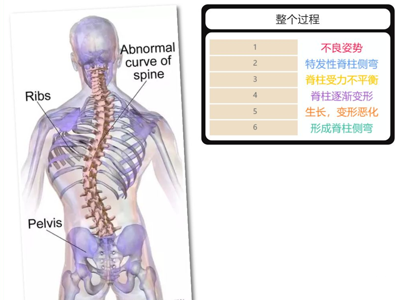 脊柱侧弯形成过程