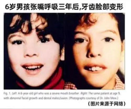 腺样体面容